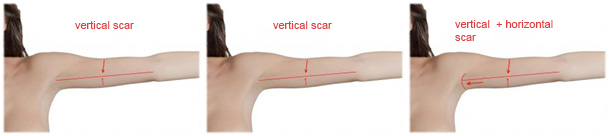 Arm-lift-scars